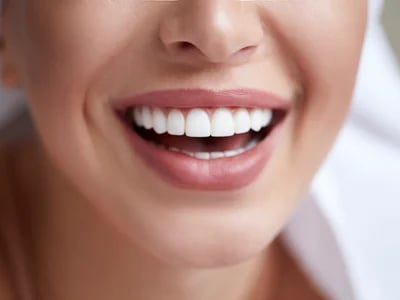 Invisalign Dauer: Wie lange dauert die Behandlung mit der transparenten Zahnschiene?
