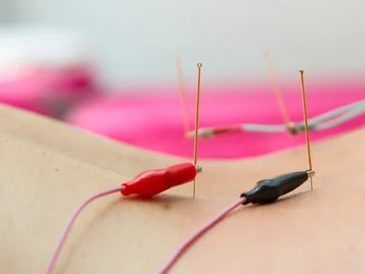 Akupunktura és a vérkeringés javítása – Akupunkturbehandlungen usw