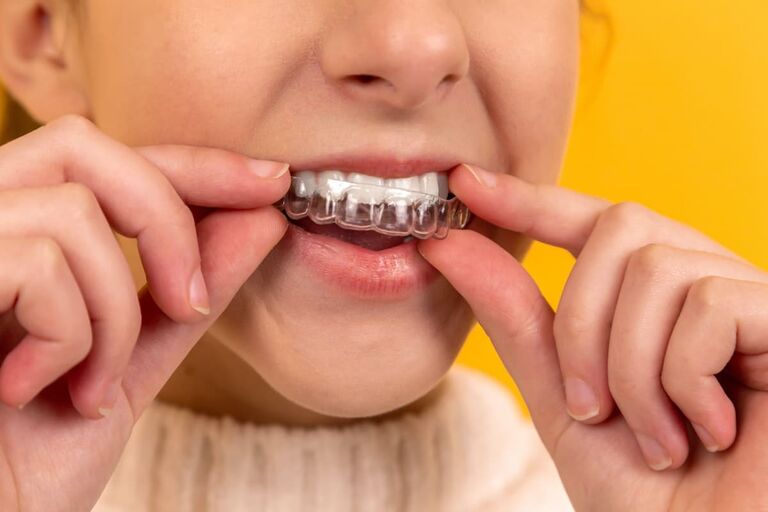 Zahnschienen für Kinder: Was Eltern wissen sollten